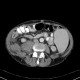 Extramedullary hematopoesis, paravertebral, splenomegally, spherocytosis, hereditary spherocytosis, intramuscular hematoma, iliacus muscle: CT - Computed tomography